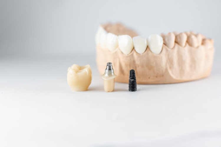 model of artificial jaw and dental implant PYXYEPD